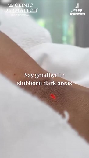 Bid goodbye to unwanted pigmentation with Q-switch laser toning! ...