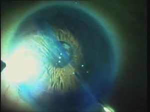 E-DMEK Fuch's Dystrophy with Cataract - Eyetube