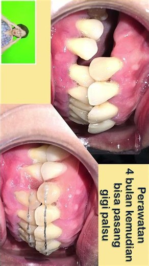 BRACES TREATMENT FOR PROTRUDING, LOOSE, AND MISSING TEETH | PART 5 OF 6