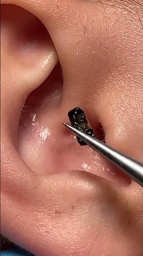Tweezer Perfection! 👃✨🧼 #ASMR #DeepClean #Extraction