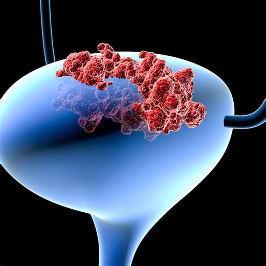 Conditions We Treat: Kidney and Bladder Stones