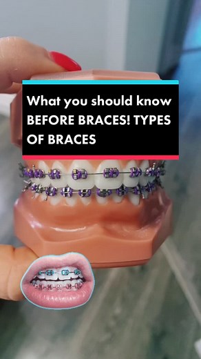 Braces By Britt Official® on TikTok