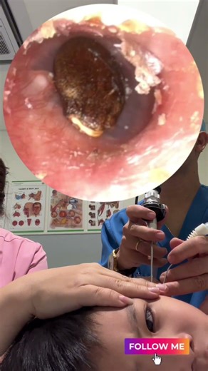 🩺 Routine Ear Check-Up — Surprising Discovery! #earhealth #doctorvisit #shorts