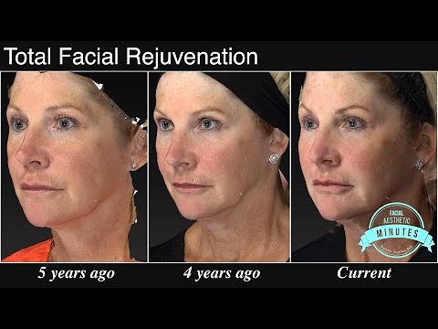 60 yo Female Facial Rejuvenation - A Refreshed Face | Aesthetic Minutes #Facelift #Blepharoplasty