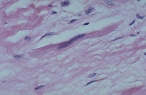 Anitschkow cell - Alchetron, The Free Social Encyclopedia