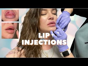 LIP FILLER before, during and after 💋 FULL HEALING EXPERIENCE | RUSSIAN TECHNIQUE