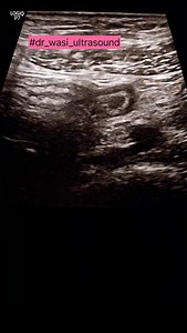 Appendicitis with mucocele #appendicitis #mucocele #appendisectomy #surgery #appendixsurgery #dr_wasi_ultrasound #ultrasonography #radiologist #medicaleducation #neetpg #abdominalultrasound # | Ultrasound made easy