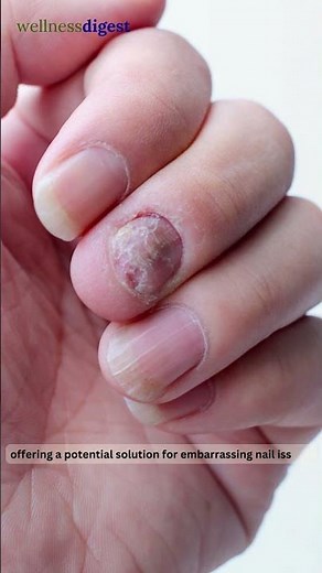 Eliminate Nail Fungus with ProNail Complex | ProNail Complex Review #nailfungus #nailcare #shorts