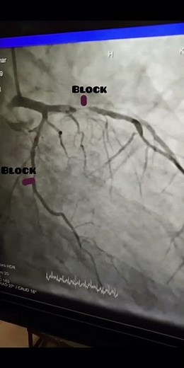 Left anterior descending (LAD) 90% blockage and left circumflex (LCX) 80% blockage