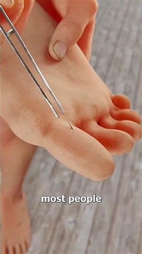 How Suction Splinter Removal Works ? #shorts