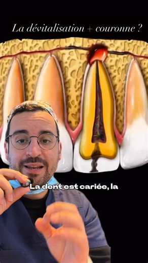 Dr Panero | Chirurgien Dentiste on Instagram: "La dévitalisation dentaire : un traitement pour sauver la dent. Douleur persistante ? La dévitalisation dentaire, aussi appelée traitement endodontique, consiste à retirer le nerf d’une dent lorsque celui-ci est atteint de façon irréversible. Contrairement aux idées reçues, ce traitement n’est pas destiné à faire mal, mais à supprimer la douleur, éliminer l’infection et conserver la dent en bouche le plus longtemps possible. Lorsque la pulpe est inf