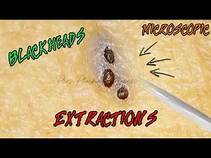 ‼️Blackhead Removal ~#33 Extraction | Compilation | Armpit | Close up| Microscopic | Satisfying‼️