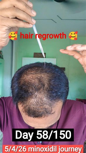 Day 58/150 Mintop Alcohol Free Minoxidil Journey | Real Results & Update | 5 April 2026