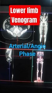 CT peripheral Angi/Veno |Venography #medicos1k86 #radiology #radiography #rad #angio #ct #shorts
