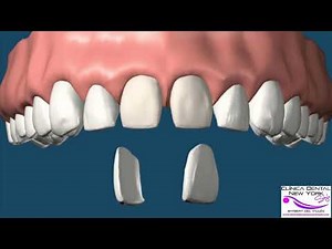 Cierre de diastema, con Carillas de Porcelana//CLÍNICA DENTAL NEW YORK STYLE(BARBERÁ DEL VALLÉS)