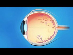 Understanding Glaucoma