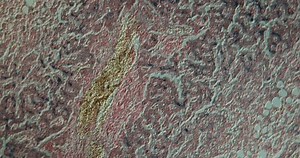 Hemosiderosis in liver under the microscope 100x
