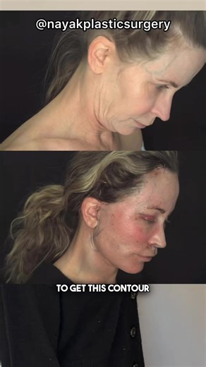 Challenges in Lisa's Cosmetic Surgery Journey