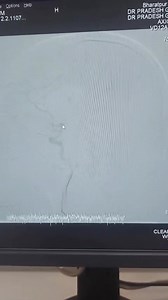 11K views · 177 reactions | First Cerebral Angiogram in 3D capable Neurointervention Cath lab Suite in Bharatpur Hospital, Chitwan | Bharatpur Hospital | Facebook