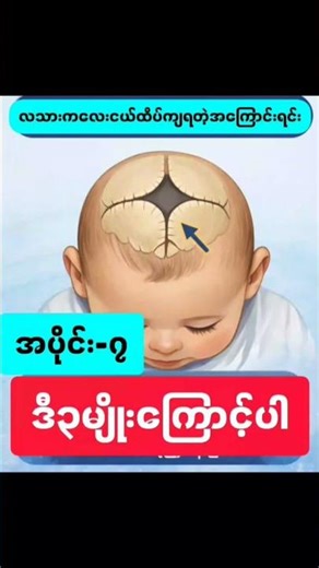 #baby Shortsလသားကလေးငယ်ထိပ်ကျရတဲ့လက္ခဏာများ