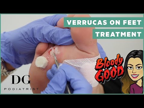 Verrucas plantar warts on feet treatment: Cryotherapy and Salicylic acid on 3 areas | DG Podiatrist