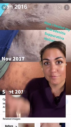 Understanding Hidradenitis Suppurativa: Symptoms, Causes, and Treatment