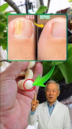 Remédio Caseiro Poderoso Que Acaba com Fungos e Micose nas Unhas Naturalmente 💅
