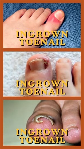 👣 Is Your Child Struggling with a Painful Toenail? 👣 Ingrown toenails are very common in kids and teens — and if left untreated, they can become painful or even infected. ⚠️ Parents, here’s what to look out for: 🔹 Redness or swelling around the nail 🔹 Pain when wearing shoes or playing sport 🔹 Signs of infection (pus or increased tenderness) These symptoms can make it uncomfortable for children to walk, enjoy activities, or wear shoes properly. At Fix My Feet Podiatry, we provide gentle and