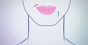 The expressions that make you "you" may cause wrinkles over time. But Restylane® Refyne and Restylane® Defyne are clinically proven to soften laugh lines while helping you maintain your natural expression (1,2,3). The most commonly observed side effects are swelling, redness, pain, bruising, headache, tenderness, lump formation, and itching at the injection site. To learn more about serious but rare side effects and full Important Safety Information, visit www.RestylaneUSA.com. 1. Data on file. 