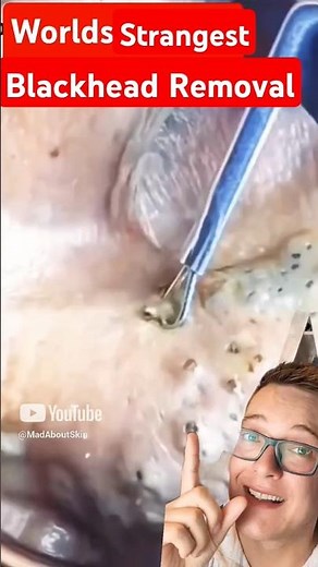 Worlds Darkest BLACKHEAD REMOVAL - Crazy Extraction #shorts