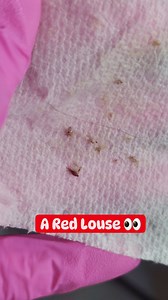 This head Louse had recently fed on blood 🩸 Did you know that Head Lice feed on human blood like mosquitoes but do not spread diseases like them. #facts #FactsOfLice #factsyouneverknew #piojos #RGVLiceLady | LRS - Lice Removal Service