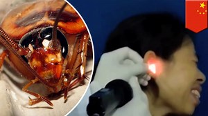 Live cockroach removed from Chinese woman’s ear