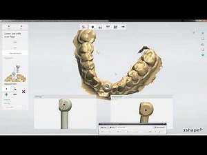 Adaptive Scanning in 3Shape & Implant Scanning Workflow