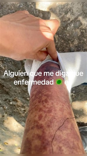 #vasculitis #fyp #sad