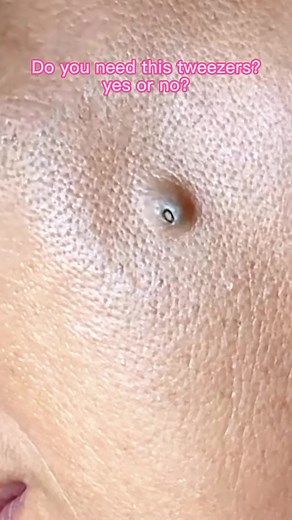 #pimple #pimplepopper #pimplepopper2022 #pimplepop #pimplepopper2021 #acne #acnetreatment #fyp #cystpopping #satisfyingvideo #skincare #removal