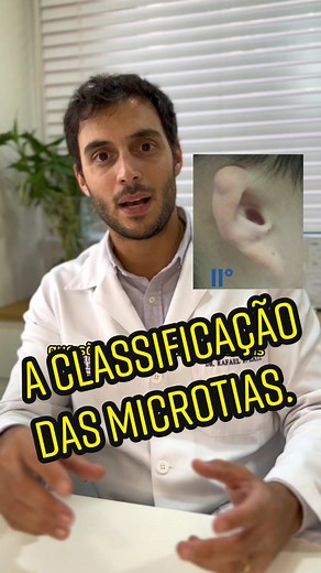 ✅️ Esse é um vídeo para vocês mães e pais de crianças com microtia, entenderem melhor a classificação desse deformidade. ✔️ O que sempre aconselho aos pais, é manter a calma diante dessa nova realidade, e buscar o máximo de informações possíveis para que seja feito o melhor tratamento. 🗣 Se tiver alguma dúvida, estou a disposição para esclarecer. 👂🏻 Dr Rafael Zatz- Cirurgião plástico CRM: 163787 RQE: 87564 #microtia #neootoplastia #cirurgiaplastica #cirurgiaplasticasaopaulo #microtiaeatresia 