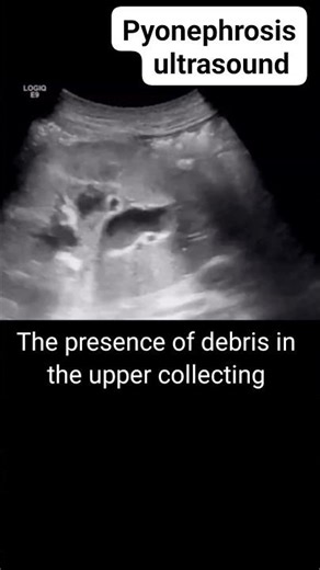 I Have a Kidney Disease - Pyelonephrosis Discussion With Specialist