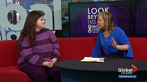 Calgarian shares personal story to raise awareness about Moebius syndrome