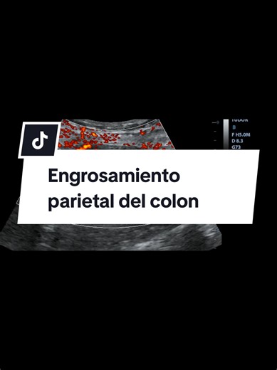 El engrosamiento concéntrico de la pared del colon ascendente es un hallazgo inespecífico que puede indicar inflamación, infección, isquemia o neoplasia. Se caracteriza por el aumento de grosor de la pared, lo que requiere evaluación por colonoscopia para diferenciar causas benignas (colitis, enfermedad de Crohn) de malignas (neoplasias). Causas Principales Neoplásicas: El engrosamiento circunferencial e irregular puede indicar un carcinoma colorrectal. Inflamatorias/Infecciosas: Colitis infecci