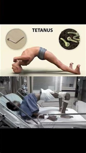 tetnus is life threatning condition caused by specific bacterial infection