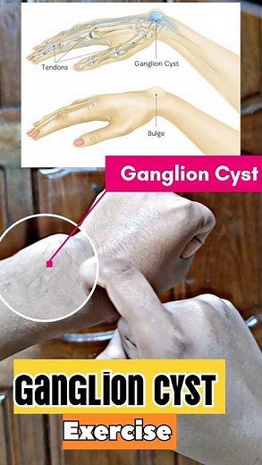 Ganglion Cyst Exercise #physiotherapy #exercise #help #treatment #wristpain