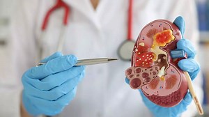 What happens after a kidney transplant? Know precaution tips, complications, recovery advice, and more