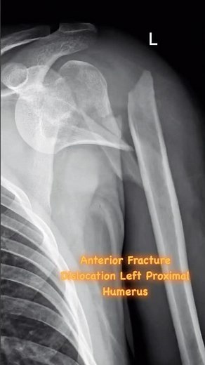 Anterior Fracture Dislocation Proximal Humerus.