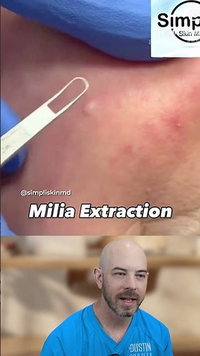 11 blade to open it, comedone extractor flat on the skin — that's exactly how we do it in the office