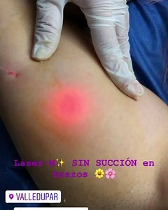 Láser-M El procedimiento de lipólisis láser sin succión es la...