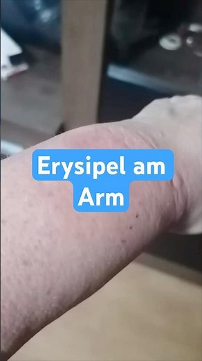 Erysipel am Arm