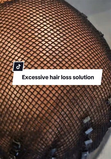 Mesh Integration System for Hair Loss Solutions