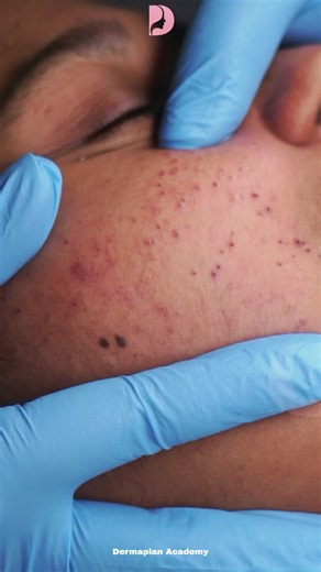 Clear Skin Starts Here Watch how we gently remove stubborn whiteheads from under the skin, revealing smooth, fresh, and glowing results Your skin deserves the best care. . . . #WhiteheadRemoval #ClearSkinJourney #SkincareSriLanka #DermaPlanAcademy #FacialTreatment #GlowUpSkin #SmoothSkinGoals #PoreCleaning #AcneCareSL #SkincareReels