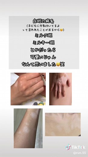 カフェオレ斑と扁平母斑の違いについて