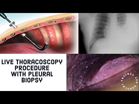 Live Thoracoscopy Procedure with Pleural Biopsy